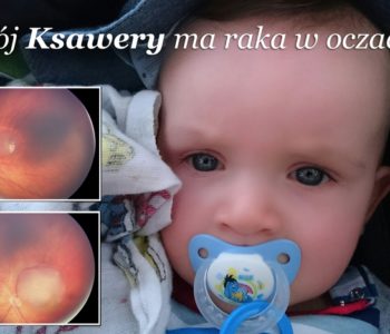 Ksawery walczy z nowotworem oczu