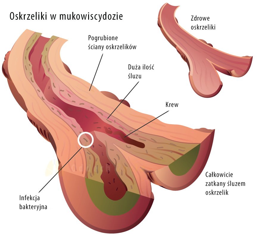 Mukowiscydoza dziecka leczenie objawy