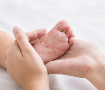 Measles virus. Mother holding tiny baby fstópka dziecka z wysypką