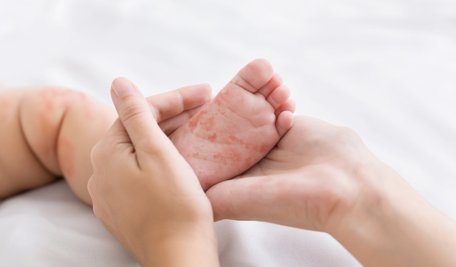 Wysypka i gorączka u dziecka – rozpoznaj 4 najczęstsze infekcje zakaźne